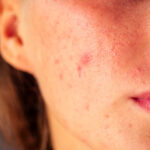 post acne scars and red festering pimples on the 2022 06 01 00 52 19 utc