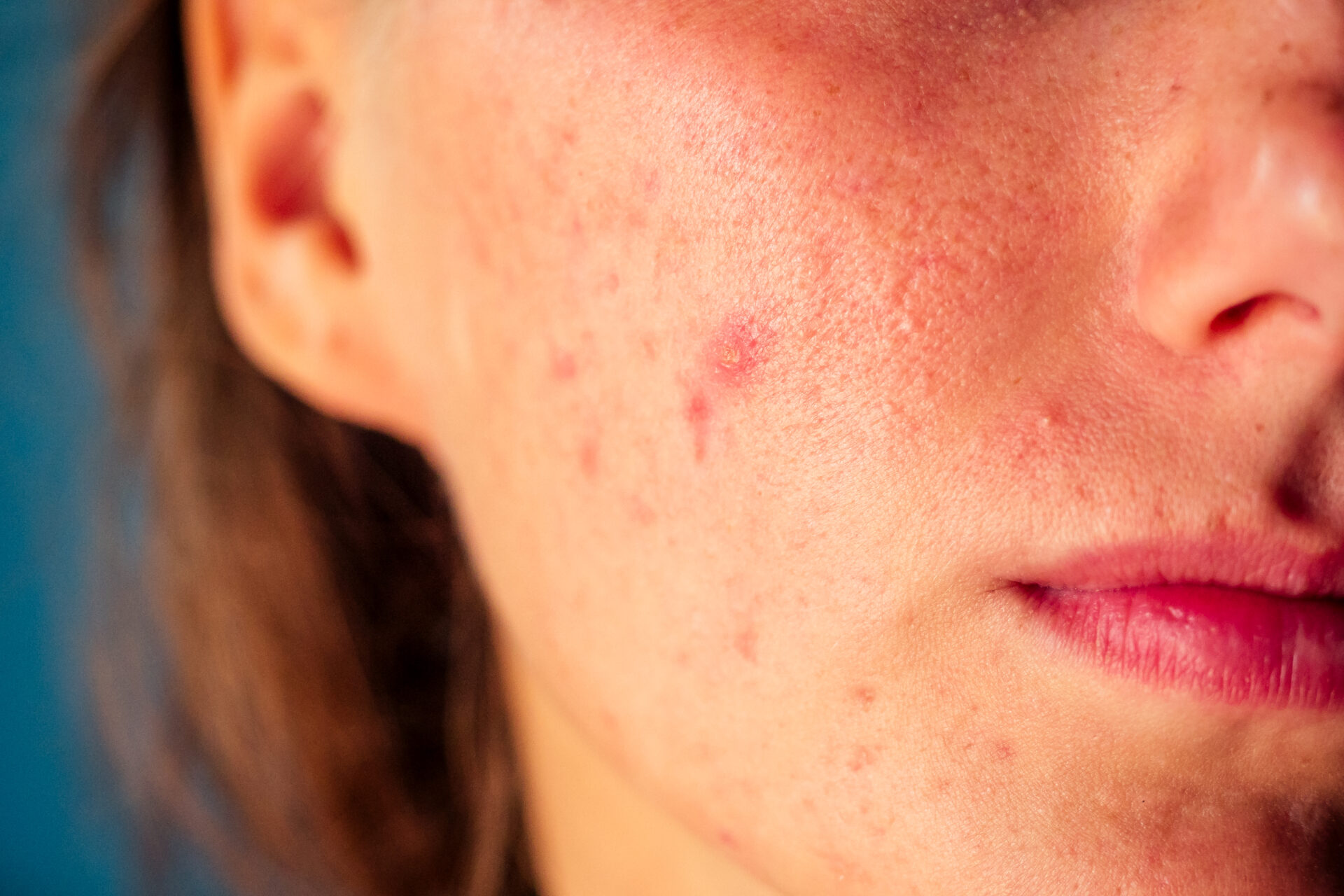 post acne scars and red festering pimples on the 2022 06 01 00 52 19 utc