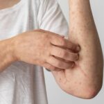 skin allergy reaction on person s arm
