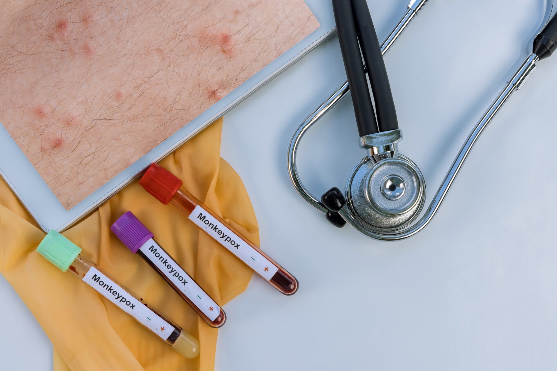 pandemic for monkeypox new virus with doctor exami 2022 08 01 04 03 18 utc