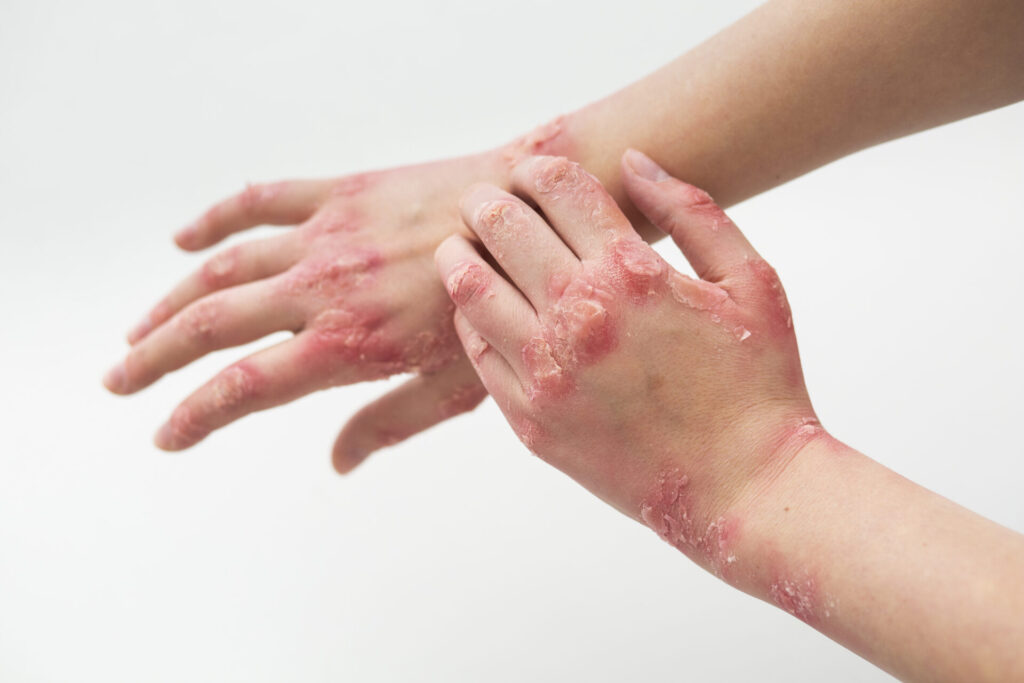 hands of patient suffering from psoriasis