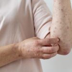 skin allergy on person s arm