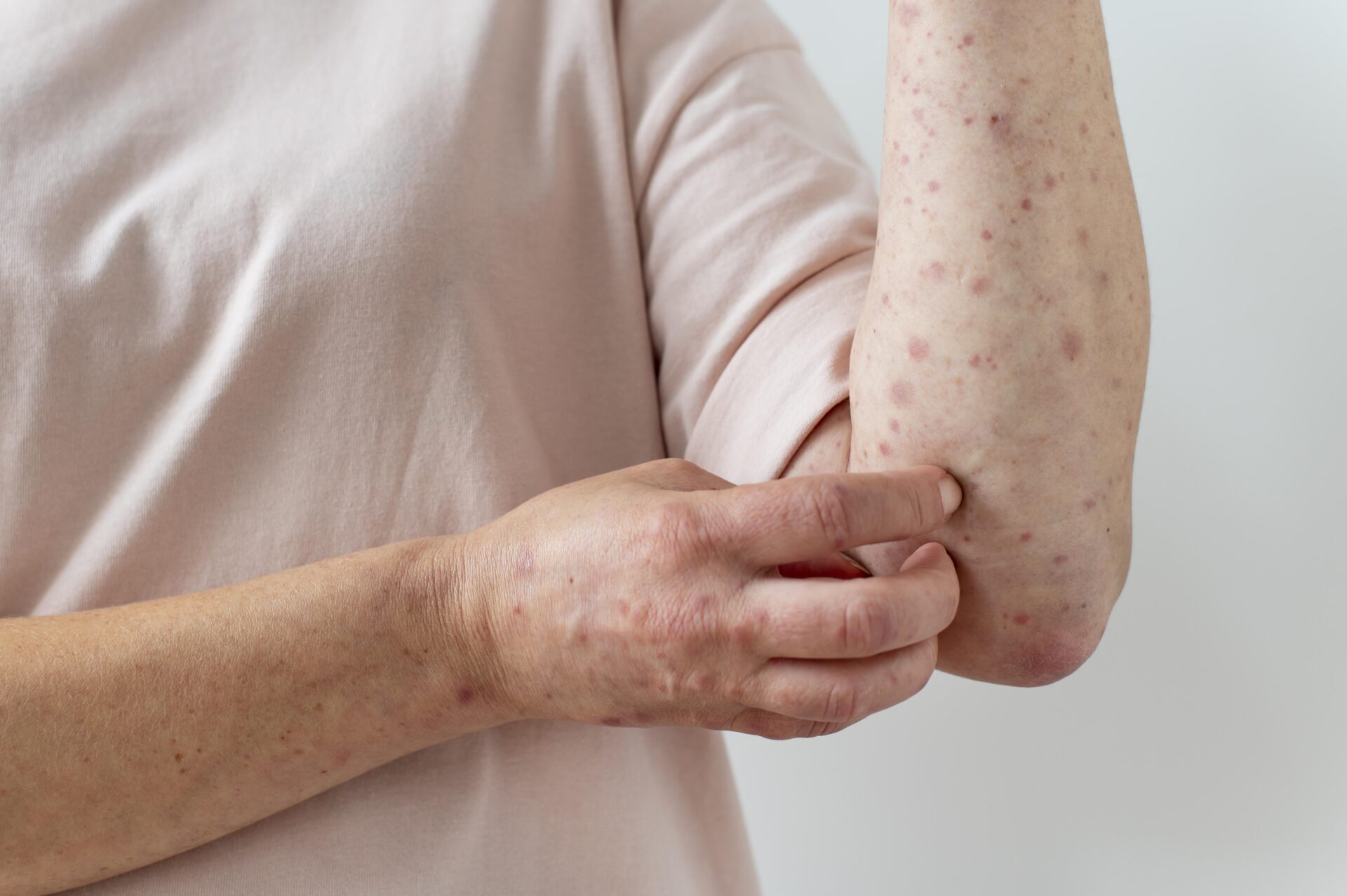 skin allergy on person s arm