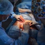 surgical team performing abdominoplasty surgery in 2022 05 28 10 48 38 utc
