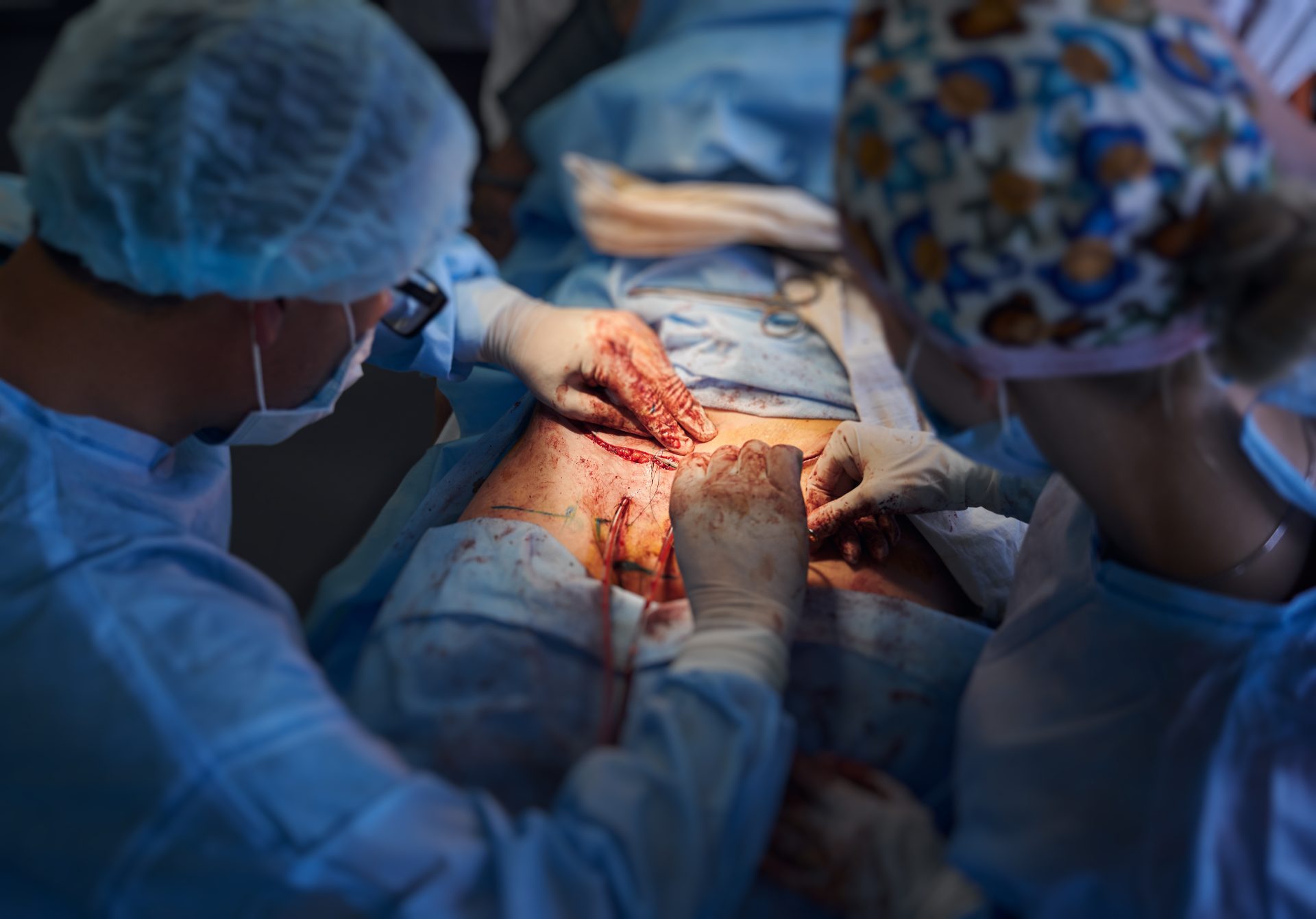surgical team performing abdominoplasty surgery in 2022 05 28 10 48 38 utc