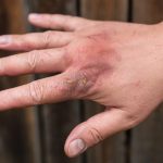 first degree skin burn hand burns wounds hot bo 2023 11 27 05 02 41 utc