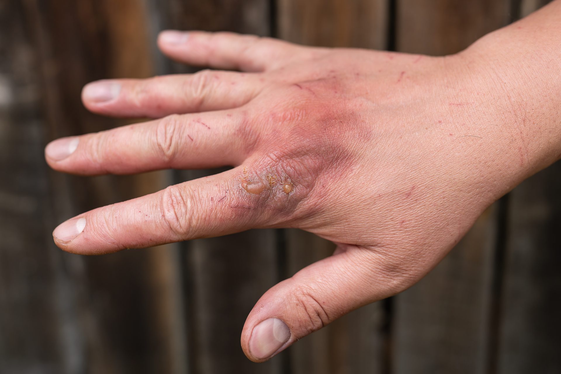 first degree skin burn hand burns wounds hot bo 2023 11 27 05 02 41 utc