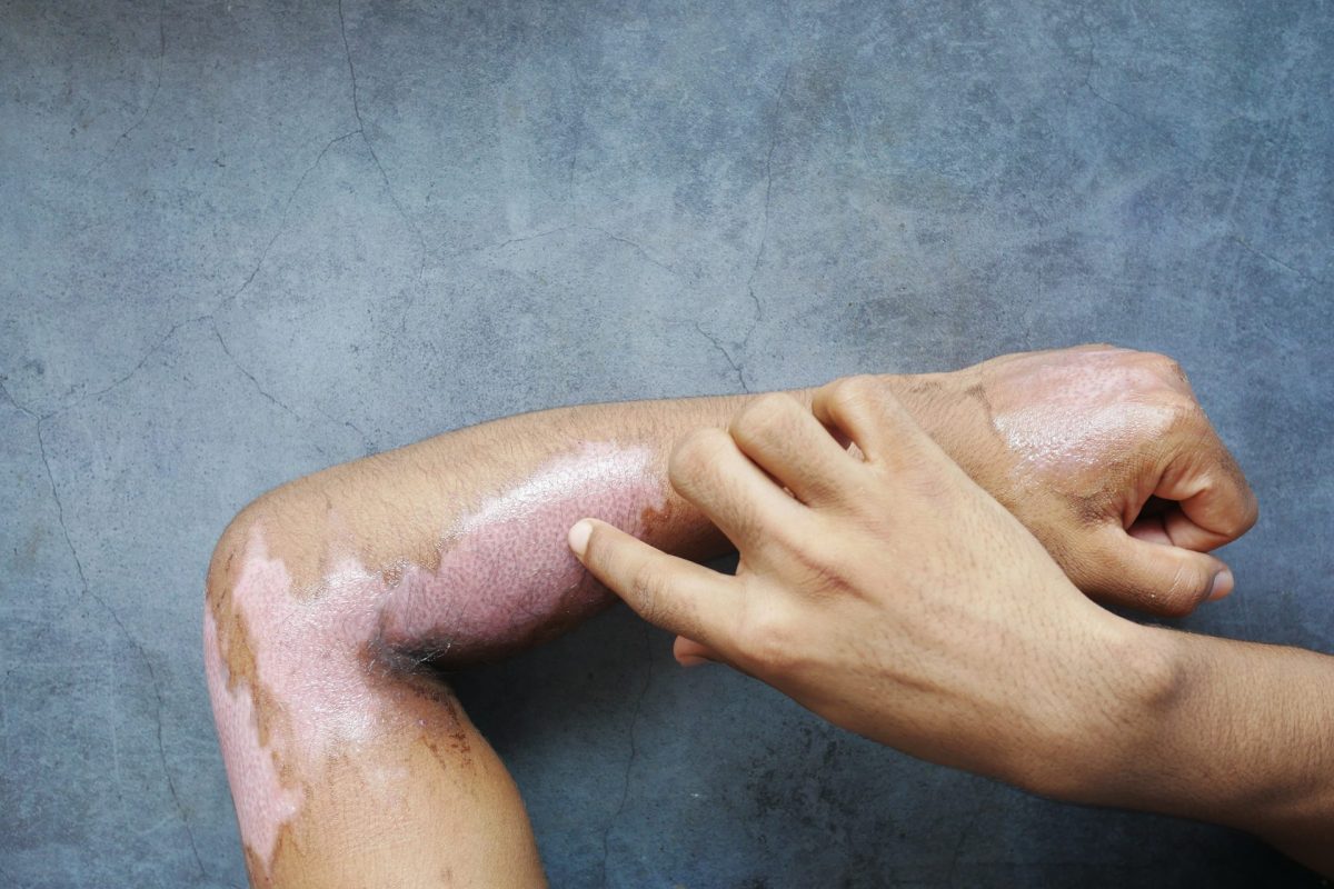 burns on man hand on black background 2024 12 13 10 51 16 utc